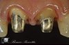 09-preparation teeth and metal recostractions.jpg