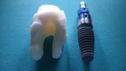 Root_analogue_ceramic_dental_implant_vs_titanium_screw_type_implant.jpg